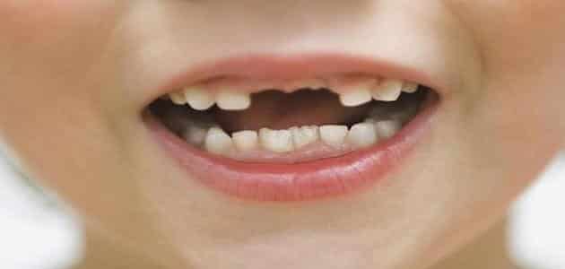 تعبیر خواب افتادن دندان های جلویی